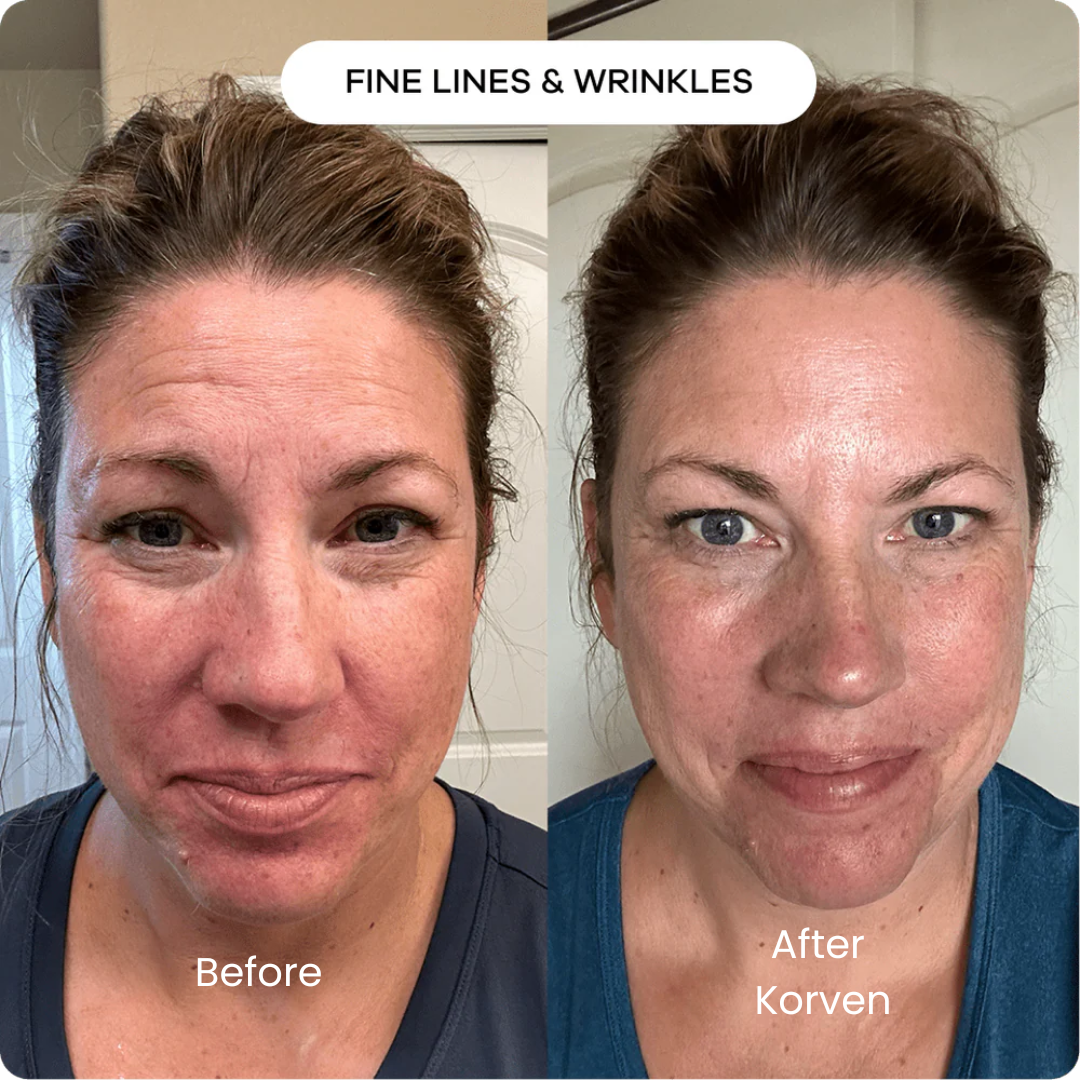 Korven Micro Infusion System™