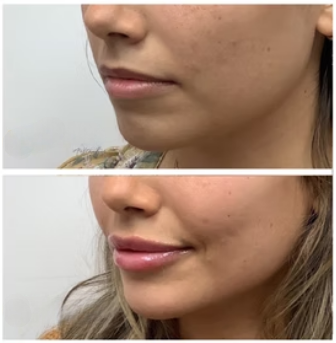 Korven Volufiline Deep Collagen Serum
